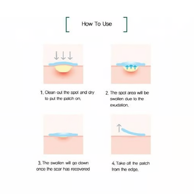 لصقات المعجزة 30 يوما لعلاج الحبوب والآثار من سوم باي مي – 18 قطعة لاصقة